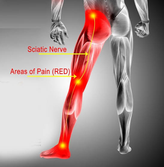 Sciatica Treatment in Fourways: Causes, Symptoms & What Actually Helps images 9 Puresymmetry